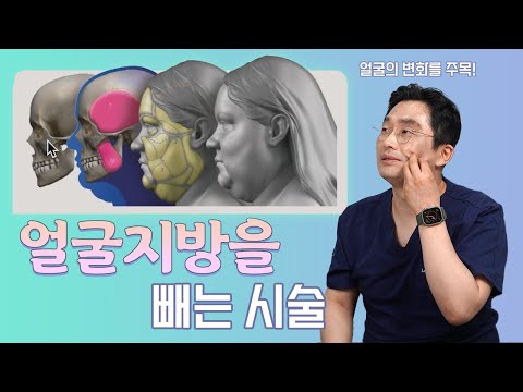 얼굴 변화를 주목! 얼굴지방을 빼는 시술