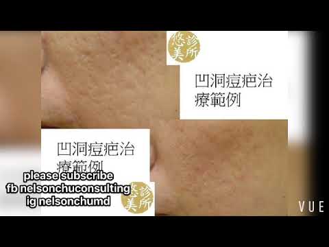 How to Eliminate Acne scar痘疤治療幾個需要知道的重點 比較案例