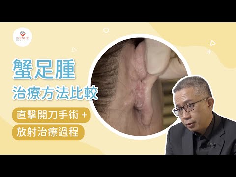 【手術室直擊】蟹足腫治療方法比較｜直擊開刀手術過程｜蟹足腫放射治療｜杏林在線