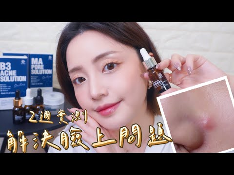 兩周就能順利消滅痘痘嗎?我的戰痘日記  feat.Dr May美博士-luffy