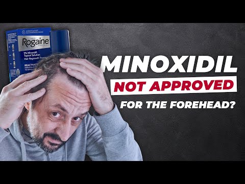 Does Minoxidil Work for Frontal Baldness