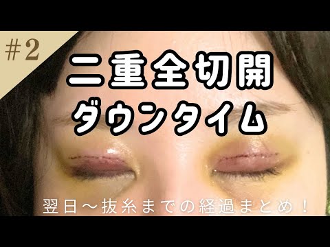 【二重全切開】ダウンタイム徹底レポ！翌日〜抜糸までの経過まとめ🔥