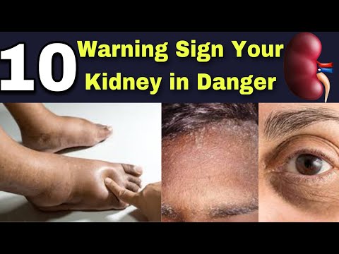 kidney failure: 10 Early Sign of kidney disease In Urdu | Hindi #kidneydisease #chronickidneydisease