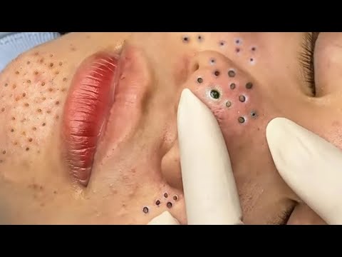 blackheads on back