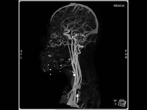 Intracranial Arterial Circulation