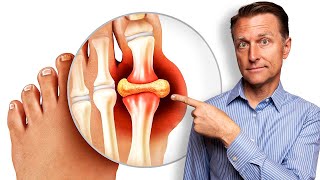 Remedy for Gout and Uric Acid - Straight From the Garden