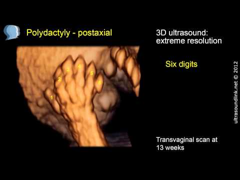 Polydactyly: 3D ultrasound amazing resolution