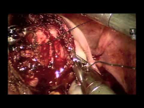 Robotic myometomy for large fibroid uterus Dr Rooma Sinha, Apollo Hospital Hyderabad India