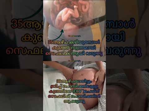 Baby's Position🤰കുഞ്ഞ് തിരിഞ്ഞു വരുമ്പോൾ 🤰#youtubeshorts #baby #pregnancy #cephalicposition #shorts