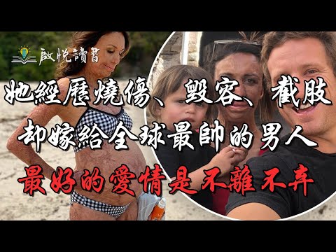 她經歷燒傷、毀容、截肢，卻嫁給全球最帥的男人！最好的愛情是不離不棄！