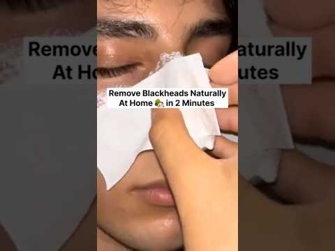 Get Rid of Blackheads & Whiteheads | Remove Blackheads Easily At Home In 1Day #shorts #viralvideo