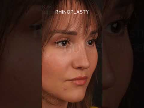 Rhinoplasty Transformation by Assoc. Prof. Dr. Güncel Öztürk | Before & After Results