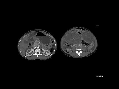 Radiology Case of the Week: The best diagnosis for this case is?