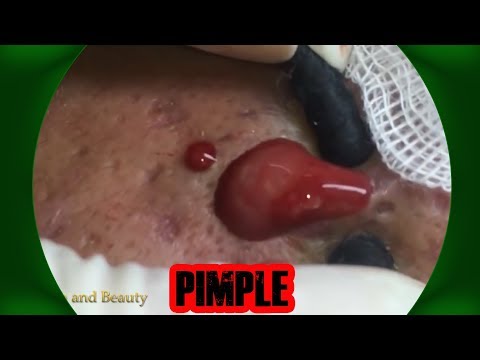 Best Pimple Popping Videos - Blackheads 2019 #11