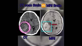 CT scan Brain 🆚 MRI Brain/Pathology detailing #aiims