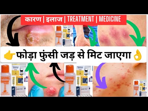 फोड़ा फुंसी कैसे ठीक करें, pimples/Acne कैसे ठीक करें, मुंहासे कैसे ठीक करें | दवा कौन सा लेना है|