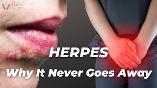 Why Herpes never goes away | The Institute of Human Anatomy