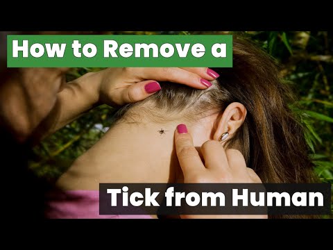 How to Remove a Tick from Human Hair - The Safe Way