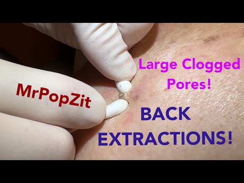 Deep clogged pores on the back extracted! Blackhead removal up close by the dozens.