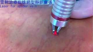 靜脈曲張表皮雷射 (laser treatment for spider vein) -  陳建彰診所 / 宇成診所 - 靜脈曲張專科診所