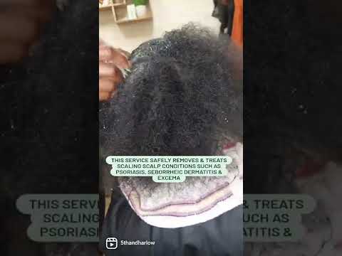 STOP SCALING, FLAKY, ITCHY scalp|Sew In Removal Service