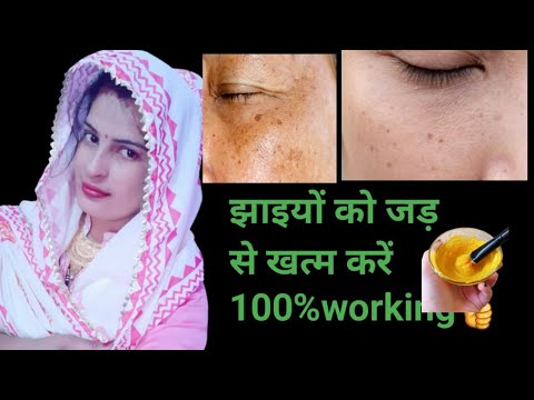 कितनी भी पुरानी झाइयाँ pigmentation जड़ से खत्म करें100% result || how to remove pigmentation