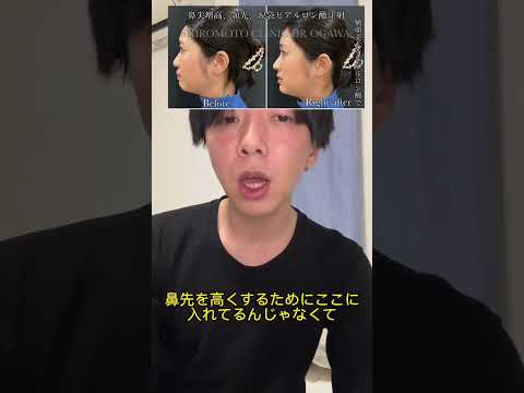 昨日アップした動画に音声が入っていなかったため、同じ動画の音声ありを再度アップします。鼻先ヒアルロン酸の解説です。