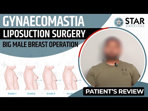 Gynaecomastia Surgery In Amritsar, Punjab | Gynecomastia Specialist | Male Boobs Surgery in Amritsar