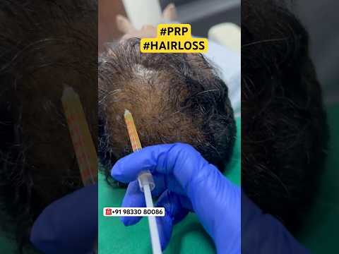 बालों का झड़ना , गंजा होना , बालों का पतला होना #hair #prp #hairtransplant #ytshorts #shorts #viral