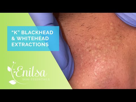 Blackhead & Whitehead Extractions on "K" - April 2022