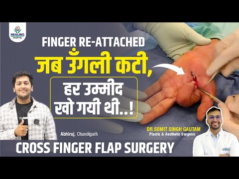 Cosmetic Surgery: My Finger Reconstruction Journey | Patient Success Story