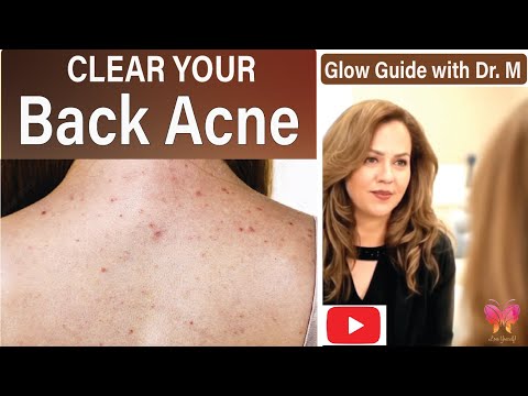 Back Acne – Tips and Treatments   Glow Guide with Dr  M