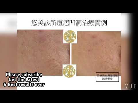 如何治療痘疤 How to fight acne scar correctly