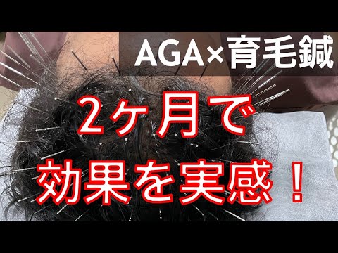 【髪の毛になんかしました？】て知り合いに言われたんですが、2ヶ月で効果はでるんですか？→解説します！！