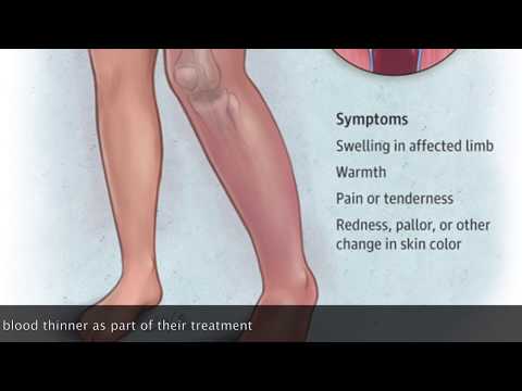 Isolated Calf Vein Thrombosis (DVT Below the Knee)