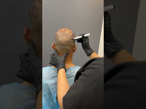 Achieving Natural Density: 4100 Hair Grafts Transplant Procedure