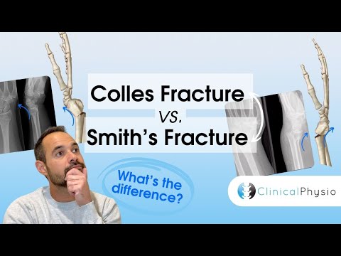 Colles Vs. Smith's Fractures | Expert Physio Guide