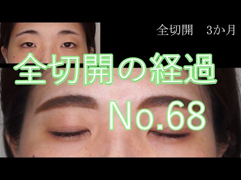 全切開　68　20代女性