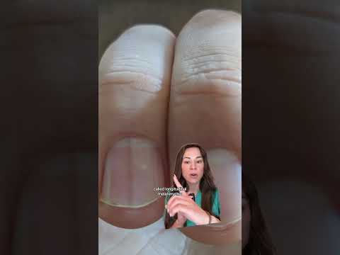 Dermatologist Reveals Dark Vertical Line On Your Nails Could Be Cancer (via Dr Lindsey Zubritsky)