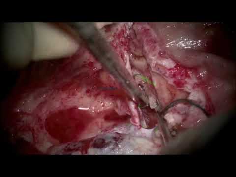 Posterior petrosectomy for resection of pontine cavernous malformation