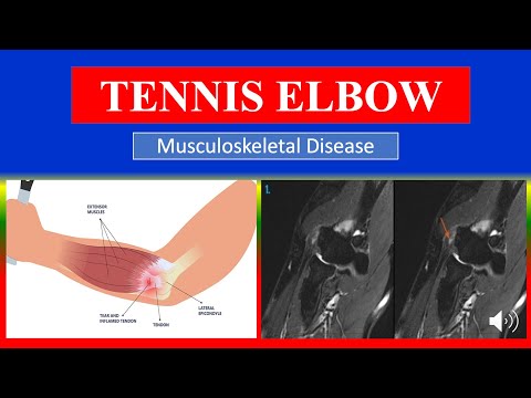 TENNIS ELBOW - Definition, types, causes, pathophysiology, symptoms , treatment , medicine