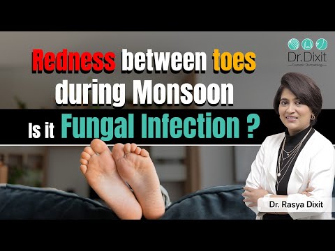 How to Treat Fungal Infection between Toes? | Fungal Infection in Rainy Season | Dr.Rasya Dixit