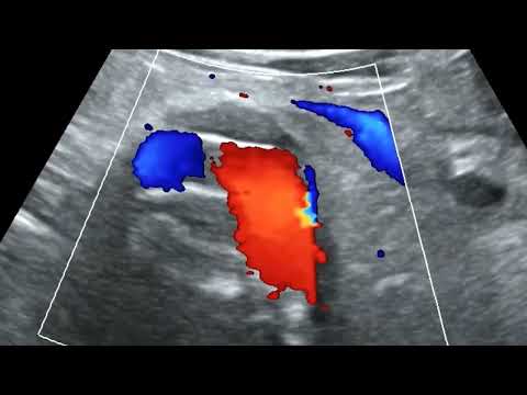 Abdominal Aortic Aneurysm - Videos of various aneurysms with Duplex Scanning