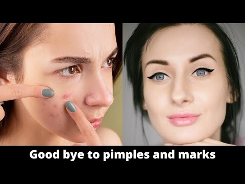 Remedy to remove pimples and marks. Pimples Dagon ko hata ne ka pure and natural nuskha.