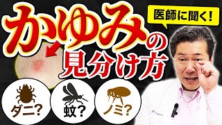 これは虫刺され？ダニ？蚊？蕁麻疹？医師が見分け方について伝授します！#虫刺され #ダニ #蕁麻疹