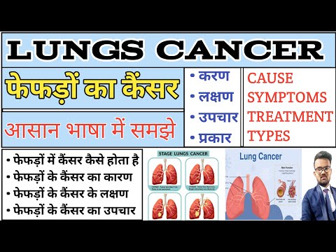 Lungs Cancer | फेफड़ों का कैंसर | Lungs Cancer in Hindi | Lungs Cancer Pathology |Lungs Cancer Notes