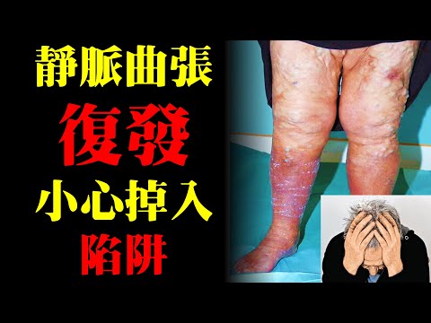 復發的靜脈曲張！為什麼那麼難治療？如何才能治療完整呢？｜許原彰醫師：台中，高雄，台南，台北，新竹，靜脈曲張專家