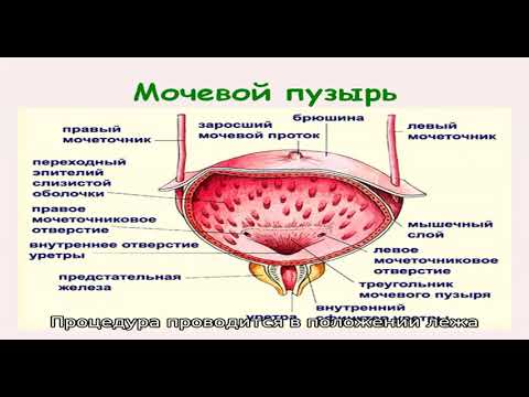 Применение Мирамистина при цистите: лечение и профилактика