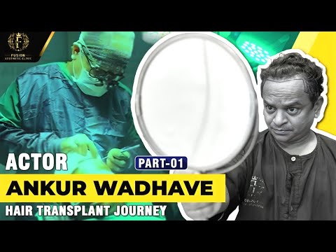 Ankur Wadhve Hair Transplant Journey