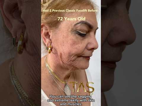 72 Years Female Amazing Transformation by Prof.Dr.Suleyman Tas